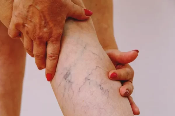What are varicose veins? Symptoms, treatment and prevention.